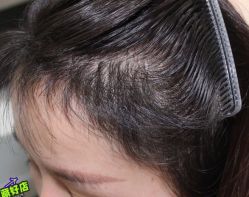 -大麦微针植发丨全国连锁
