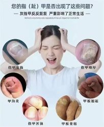 -德哥灰指甲脚气甲沟炎跖疣护理