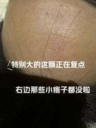 -清疣美疣·痣·斑净肤中心