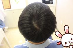 点击看大图 -大麦微针植发丨全国连锁