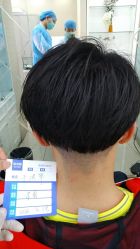 -大麦微针植发丨全国连锁