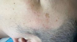 -爱莎扁平疣·汗管瘤·斑痣中心
