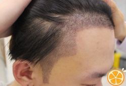 -大麦微针植发丨全国连锁