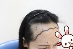 点击看大图 -大麦微针植发丨全国连锁