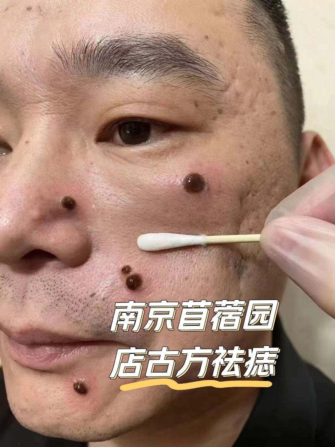 "面无善痣,方为贵,人无障痣,事平安"的古语
