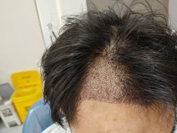 -大麦微针植发全国连锁