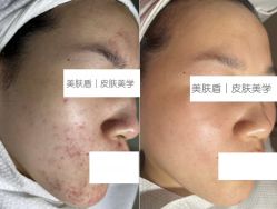 -美肤盾祛痘·问题肌头疗管理中心