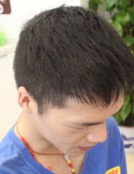 -大麦微针植发全国连锁