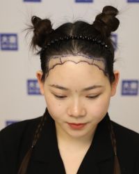 点击看大图 体验前-大麦微针植发全国连锁
