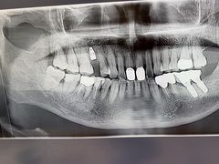 -上海仁爱医院口腔科 · 种植