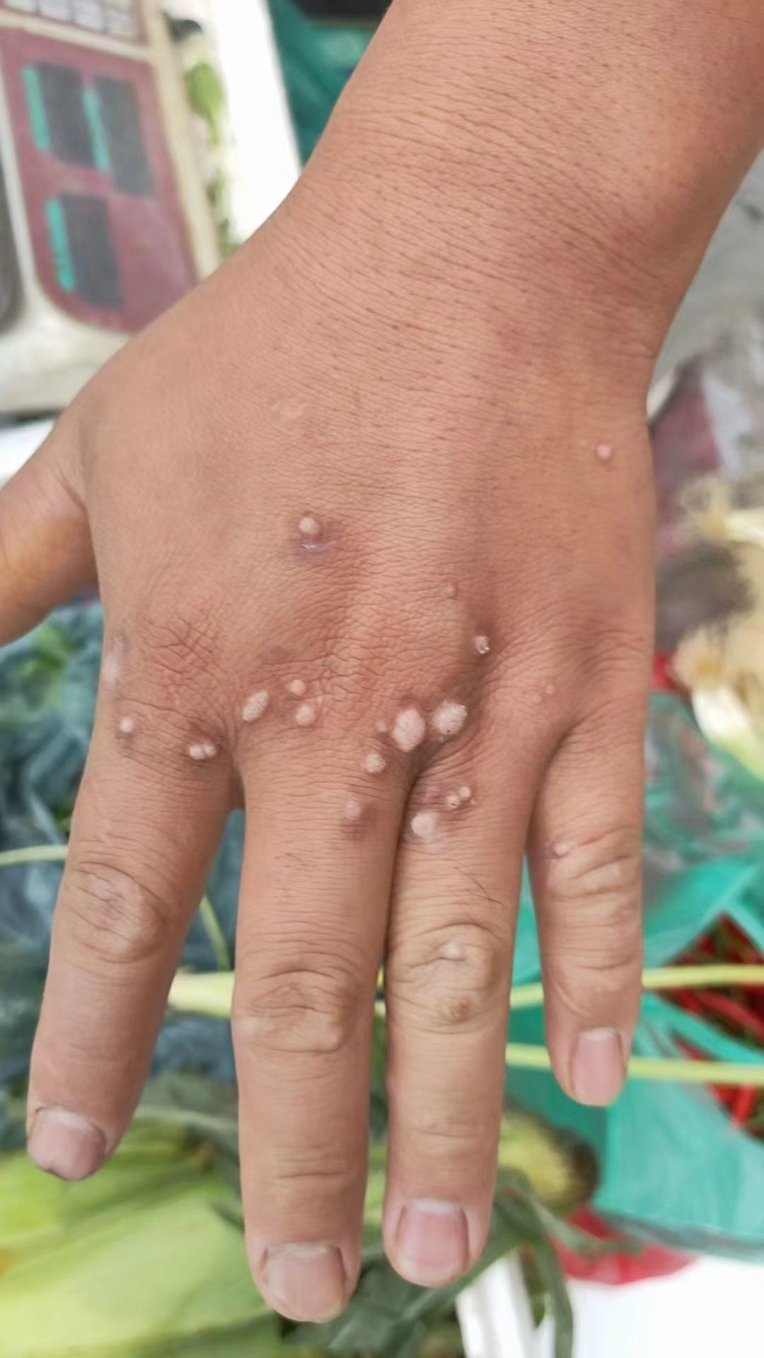 "疣"为何物,何以解"疣"?