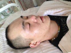 治完后，不是很红肿-苗方清颜专业祛痘