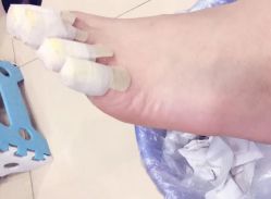 -EPAI·灰指甲·甲沟炎·嵌甲护理