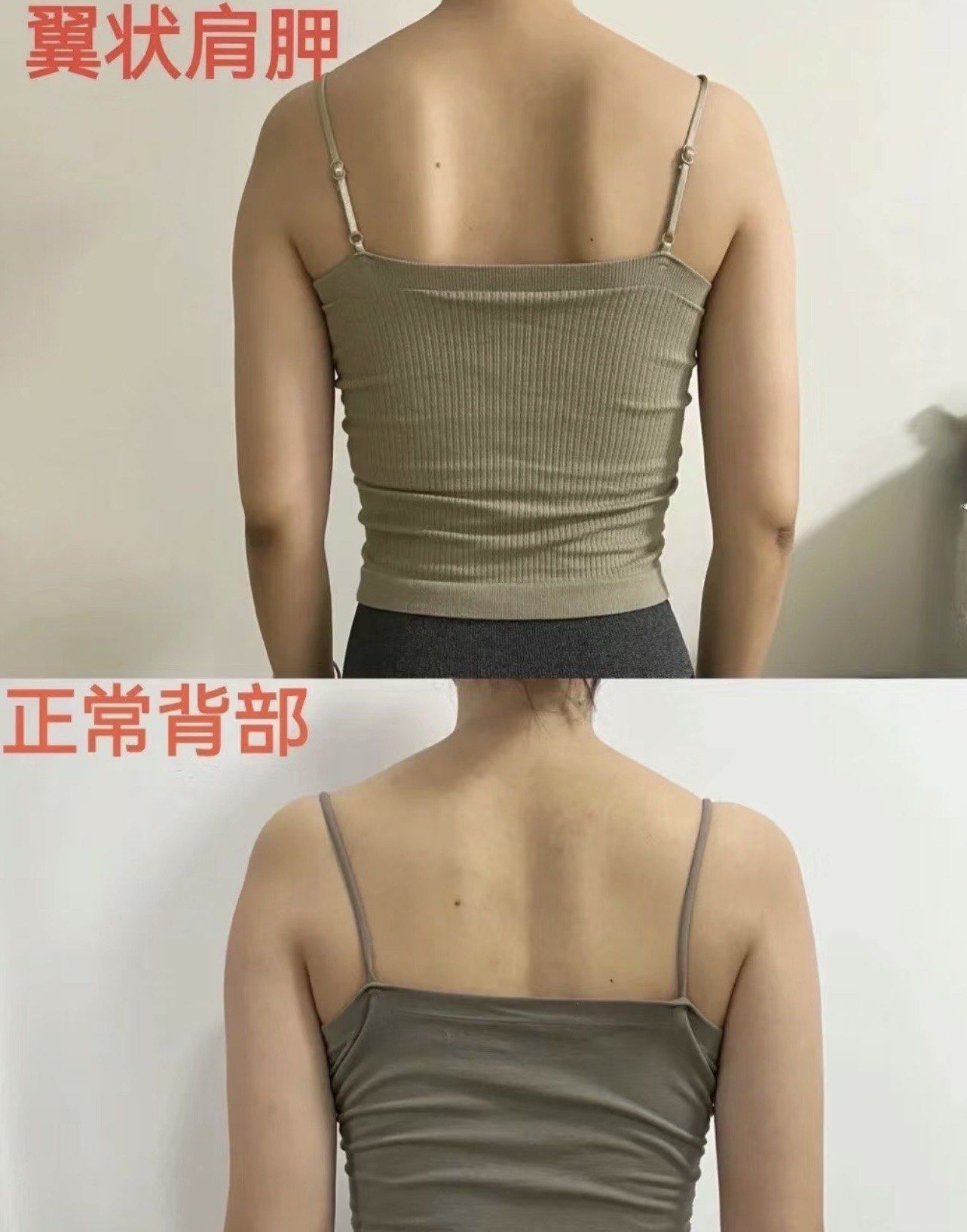 🎈
📌翼状肩胛骨的形态👇
正常的肩胛骨应该紧贴背部,呈现