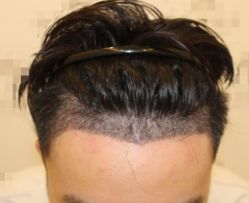 -大麦微针植发全国连锁