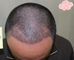 -大麦微针植发丨全国连锁