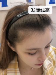 点击看大图 -大麦微针植发全国连锁