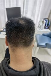 -大麦微针植发丨全国连锁