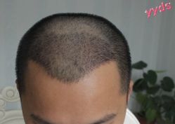 -大麦微针植发丨全国连锁