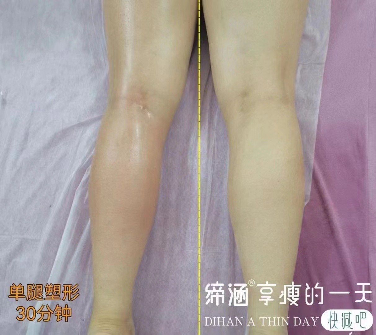 腿部塑形一次的效果 有需要的姐妹👭快来体验吧