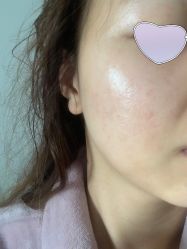 点击看大图 体验后-成都艾特他整形外科医院