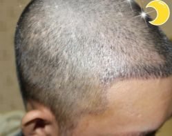 -大麦微针植发丨全国连锁