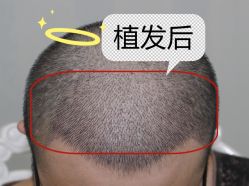 -大麦微针植发全国连锁