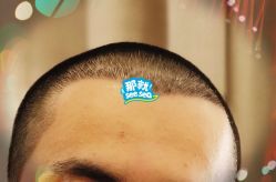 -大麦微针植发全国连锁