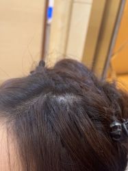 -碧莲盛·不剃发植发