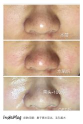 opt光疗-光SPA科技美肤