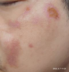 -痣缘宫