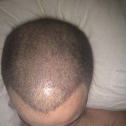 -大麦微针植发丨全国连锁