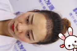 -大麦微针植发丨全国连锁