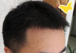 -大麦微针植发丨全国连锁