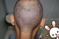 -大麦微针植发丨全国连锁