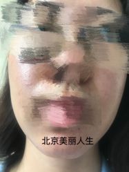 -美丽人生祛斑扁平疣汗管瘤中心