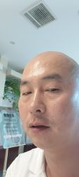 体验后-美丽人生祛斑扁平疣汗管瘤中心