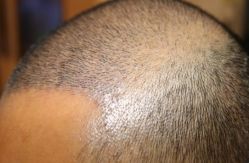 -大麦微针植发全国连锁