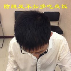 -碧莲盛·不剃发植发