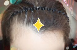 -大麦微针植发全国连锁