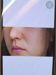 体验前-杭州米兰柏羽医疗美容医院