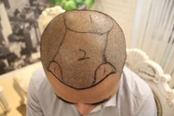 点击看大图 -大麦微针植发丨全国连锁