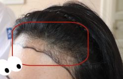 -大麦微针植发全国连锁