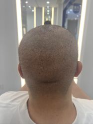 点击看大图 -大麦微针植发全国连锁