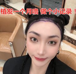 -碧莲盛·不剃发植发