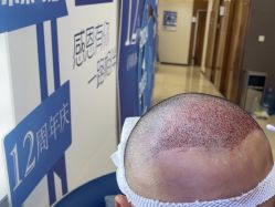 体验后-大麦微针植发全国连锁