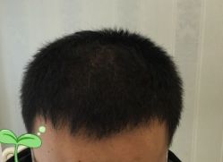 -大麦微针植发丨全国连锁