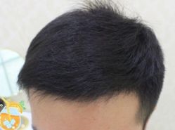 -大麦微针植发丨全国连锁