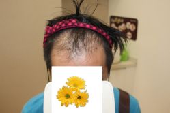 -大麦微针植发丨全国连锁