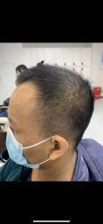 点击看大图 -大麦微针植发全国连锁